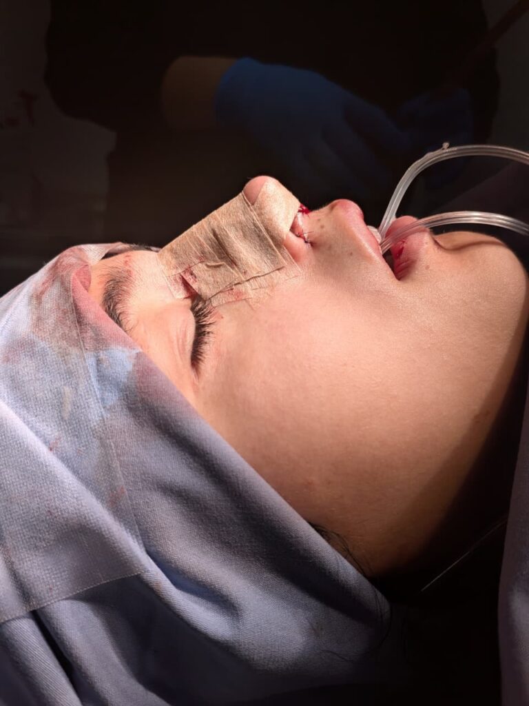 Después: Rinoseptumplastia — Postoperatorio inmediato