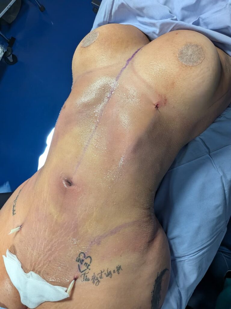 Después: Lipo HD 360° — Postoperatorio inmediato