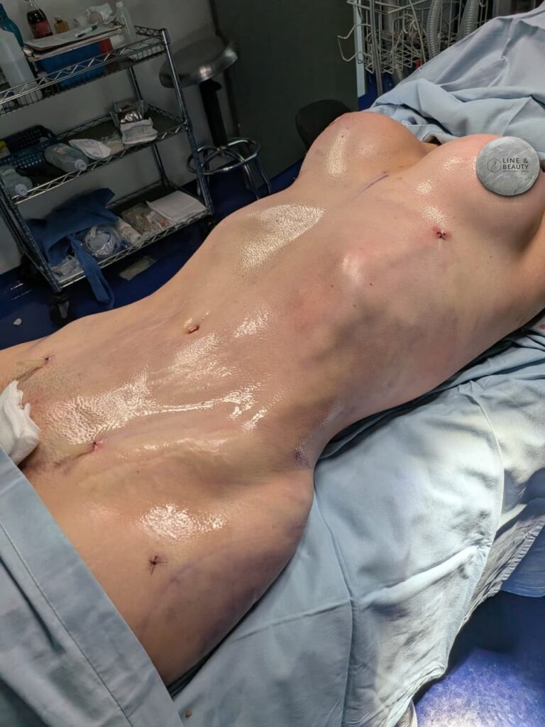 Después: Lipo HD 360° + mastopexia — Postoperatorio inmediato