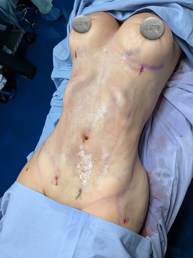 Después: Lipo HD 360° + pexia mamaria — Postoperatorio inmediato